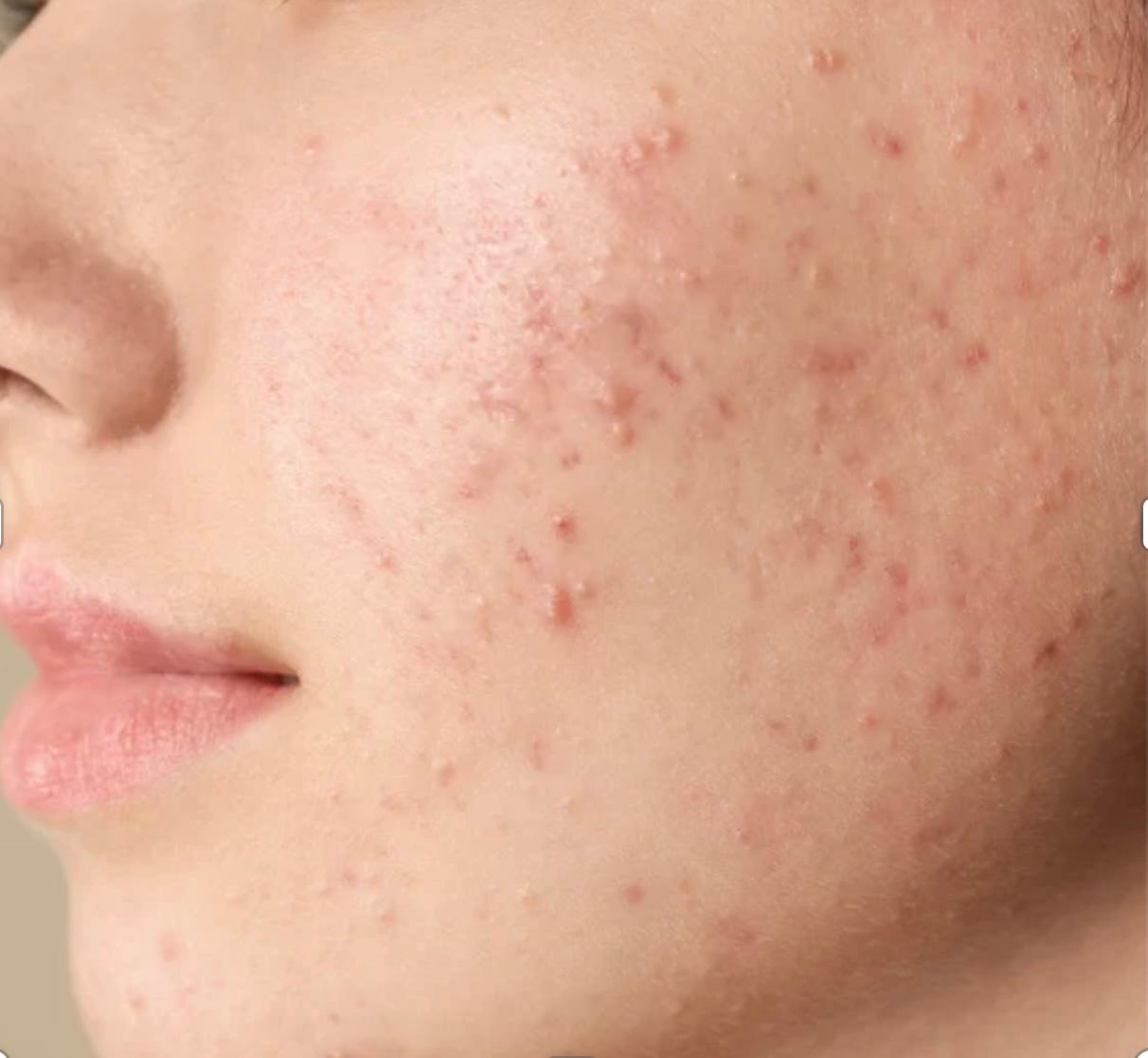 Acné